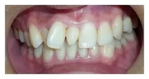 Supernumerary teeth, permanent dentition